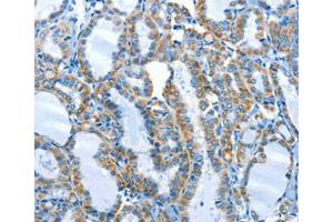 Immunohistochemical analysis of paraffin-embedded Human thyroid cancer tissue using at dilution 1/25.
