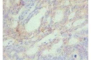 Immunohistochemistry of paraffin-embedded human colon cancer using ABIN7150954 at dilution of 1:100 (CBX4 antibody  (AA 401-560))