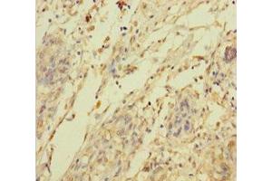 Immunohistochemistry of paraffin-embedded human pancreatic cancer using ABIN7144705 at dilution of 1:100 (C2orf49 antibody  (AA 1-232))