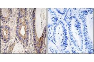 Immunohistochemistry analysis of paraffin-embedded human colon carcinoma tissue, using UPF1 Antibody. (RENT1/UPF1 antibody  (AA 299-348))