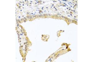 Immunohistochemistry of paraffin-embedded human lung cancer using PRKCA antibody (ABIN5970097) at dilution of 1/100 (40x lens). (PKC alpha antibody  (C-Term))