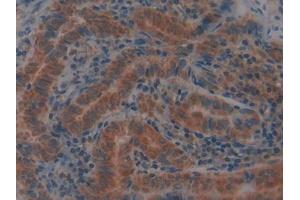 IHC-P analysis of Human Thyroid cancer Tissue, with DAB staining. (GPX4 antibody  (AA 74-197))
