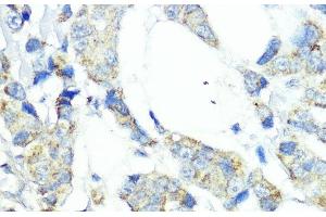 Immunohistochemistry of paraffin-embedded Human mammary cancer using NOD1 Polyclonal Antibody at dilution of 1:100 (40x lens). (NOD1 antibody)