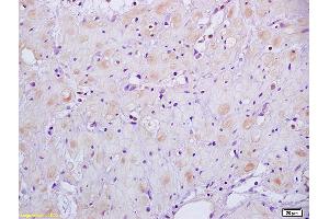 Formalin-fixed and paraffin embedded human gastric carcinoma labeled with Anti-HSD17B1 Polyclonal Antibody, Unconjugated (ABIN750178) at 1:200 followed by conjugation to the secondary antibody and DAB staining