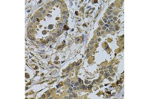 Immunohistochemistry of paraffin-embedded human breast cancer using HMGCR Antibody (ABIN6293217) at dilution of 1:100 (40x lens).