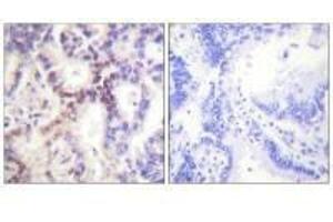 Immunohistochemical analysis of paraffin-embedded human lung carcinoma tissue using p15 INK antibody. (CDKN2B antibody)