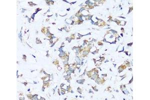 Immunohistochemistry of paraffin-embedded Human breast cancer using ATP5I Polyclonal Antibody at dilution of 1:100 (40x lens). (ATP5I antibody)