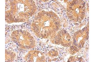 IHC-P Image Insulin Receptor antibody detects INSR protein at cytosol on human gastric cancer by immunohistochemical analysis.