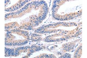 The image on the left is immunohistochemistry of paraffin-embedded Human colon cancer tissue using ABIN7190789(GFRA4 Antibody) at dilution 1/40, on the right is treated with synthetic peptide. (GFRA4 antibody)