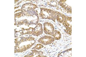 Immunohistochemistry of paraffin-embedded human colon carcinoma using  Rabbit mAb (ABIN7265363) at dilution of 1:25 (40x lens). (ACAT1 antibody)