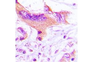 Immunohistochemical analysis of NIP1 staining in human lung cancer formalin fixed paraffin embedded tissue section. (BNIP1 antibody  (C-Term))