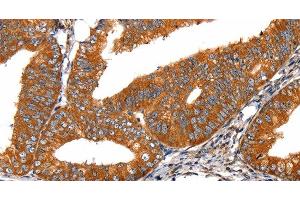 Immunohistochemistry of paraffin-embedded Human cervical cancer tissue using FGFR1 Polyclonal Antibody at dilution 1:60 (FGFR1 antibody)