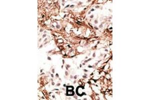 Formalin-fixed and paraffin-embedded human cancer tissue reacted with the primary antibody, which was peroxidase-conjugated to the secondary antibody, followed by AEC staining. (MAP1LC3A antibody  (N-Term))