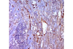 Paraformaldehyde-fixed, paraffin embedded human cervical cancer; Antigen retrieval by boiling in sodium citrate buffer (pH6.