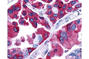 Anti-PTGER4 / EP4 antibody IHC of human Lung, Adenocarcinoma. (PTGER4 antibody  (C-Term))