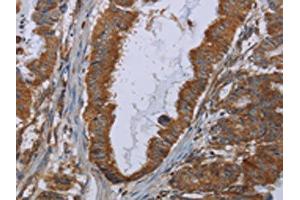 The image on the left is immunohistochemistry of paraffin-embedded Human esophagus cancer tissue using ABIN7129900(INSIG2 Antibody) at dilution 1/30, on the right is treated with fusion protein. (INSIG2 antibody)
