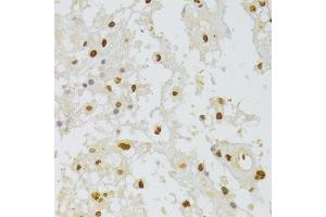 Immunohistochemistry of paraffin-embedded human brain astrocytoma using HNRNPA1 Antibody (ABIN5975570) at dilution of 1/100 (40x lens). (HNRNPA1 antibody)
