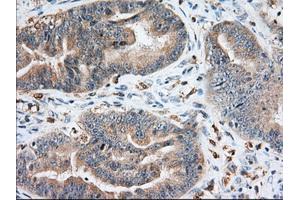 Immunohistochemical staining of paraffin-embedded Adenocarcinoma of Human colon tissue using anti-IGF2BP2 mouse monoclonal antibody. (IGF2BP2 antibody)