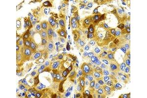 Immunohistochemistry of paraffin-embedded Human liver cancer using CDK20 Polyclonal Antibody at dilution of 1:100 (40x lens). (CCRK antibody)