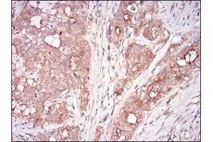 Immunohistochemical analysis of paraffin-embedded cervical cancer tissues using MSTN mouse mAb with DAB staining. (MSTN antibody  (AA 24-266))