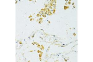 Immunohistochemistry of paraffin-embedded human lung cancer using SIRT2 antibody.
