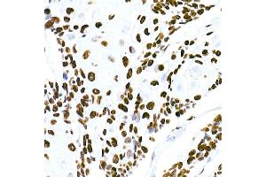 Immunohistochemistry of paraffin-embedded human esophageal cancer using HNRNPM Rabbit mAb (ABIN7267635) at dilution of 1:100 (40x lens). (HNRNPM antibody)