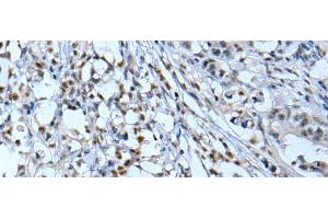 Immunohistochemistry of paraffin-embedded Human gastric cancer tissue using NF1 Polyclonal Antibody at dilution of 1:65(x200) (Neurofibromin 1 antibody)