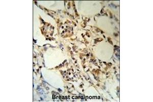 RBM3 Antibody (C-term) (R) IHC analysis in formalin fixed and paraffin embedded human breast carcinoma followed by peroxidase conjugation of the secondary antibody and DAB staining. (RBM3 antibody  (C-Term))