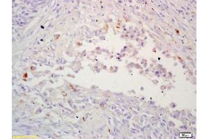 Formalin-fixed and paraffin embedded human lung carcinoma labeled with Rabbit Anti LRP/MVP Polyclonal Antibody, Unconjugated (ABIN671586) at 1:200 followed by conjugation to the secondary antibody and DAB staining (MVP antibody  (AA 88-180))