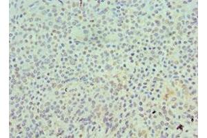 Immunohistochemistry of paraffin-embedded human breast cancer using ABIN7168550 at dilution of 1:100 (SKP1 antibody  (AA 1-163))