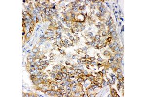 Anti- GCLC antibody, IHC(P) IHC(P): Human Lung Cancer Tissue (GCLC antibody  (AA 437-637))