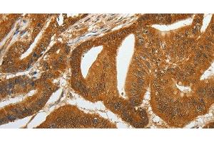 Immunohistochemistry of paraffin-embedded Human colon cancer tissue using RETNLB Polyclonal Antibody at dilution 1:40