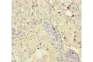 Immunohistochemistry of paraffin-embedded human lung cancer using ABIN7152960 at dilution of 1:100
