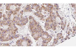 ABIN6279113 at 1/100 staining Human liver cancer tissue by IHC-P. (SCNN1A antibody  (Internal Region))