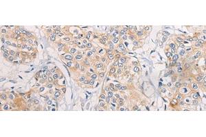 Immunohistochemistry of paraffin-embedded Human prost at e cancer tissue using CPD Polyclonal Antibody at dilution of 1:70(x200) (CPD antibody)