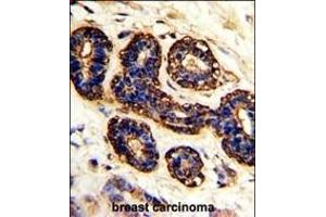 Formalin-fixed and paraffin-embedded human breast carcinoma with BEST2 Antibody (C-term), which was peroxidase-conjugated to the secondary antibody, followed by DAB staining. (Bestrophin 2 antibody  (C-Term))