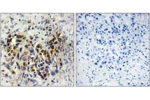 Immunohistochemistry analysis of paraffin-embedded human breast carcinoma tissue, using IRX3 Antibody. (IRX3 antibody  (AA 271-320))