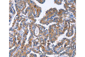 Immunohistochemistry of Human liver cancer using IGSF10 Polyclonal Antibody at dilution of 1:50 (IGSF10 antibody)