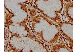IHC image of ABIN7169084 diluted at 1:300 and staining in paraffin-embedded human stomach cancer performed on a Leica BondTM system. (PKN3 antibody  (AA 1-252))