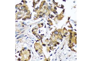 Immunohistochemistry of paraffin-embedded human lung cancer using Ube2N/Ubc13 Rabbit mAb (ABIN7271179) at dilution of 1:100 (40x lens). (UBE2N antibody)