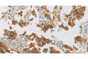 Immunohistochemistry of paraffin-embedded Human thyroid cancer using IDH3G Polyclonal Antibody at dilution of 1:30 (IDH3G antibody)