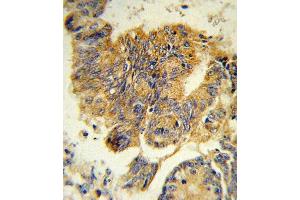 Formalin-fixed and paraffin-embedded human colon carcinoma reacted with CSF3R Antibody (Center), which was peroxidase-conjugated to the secondary antibody, followed by DAB staining. (CSF3R antibody  (AA 252-280))