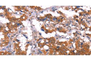 Immunohistochemistry of paraffin-embedded Human thyroid cancer tissue using HCAR2 Polyclonal Antibody at dilution 1:40 (HCAR2 antibody)