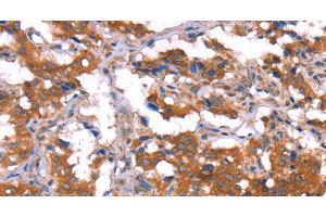 Immunohistochemistry of paraffin-embedded Human thyroid cancer tissue using HCAR2 Polyclonal Antibody at dilution 1:40