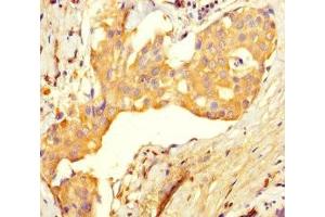 Immunohistochemistry of paraffin-embedded human breast cancer using ABIN7174485 at dilution of 1:100 (Ube2t antibody  (AA 1-197))