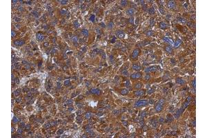 IHC-P Image Immunohistochemical analysis of paraffin-embedded human hepatoma, using TXNDC5, antibody at 1:500 dilution.