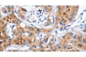 Immunohistochemistry of paraffin-embedded Human lung cancer using NCK1 Polyclonal Antibody at dilution of 1:30 (NCK1 antibody)