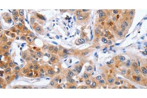 Immunohistochemistry of paraffin-embedded Human lung cancer using NCK1 Polyclonal Antibody at dilution of 1:30 (NCK1 antibody)