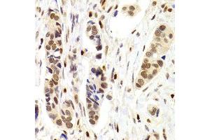 Immunohistochemistry of paraffin-embedded Human mammary cancer using NASP antibody at dilution of 1:100 (x400 lens). (NASP antibody)