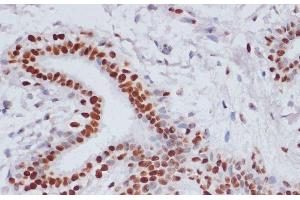 Immunohistochemistry of paraffin-embedded Human breast cancer using Acetyl-Histone H3-K9/K14/K18/K23/K27 Polyclonal Antibody at dilution of 1:100 (40x lens). (Histone 3 antibody  (acLys9, acLys14, acLys18, acLys23, acLys27))